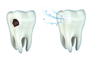 Tooth Cavity And Remineralization 