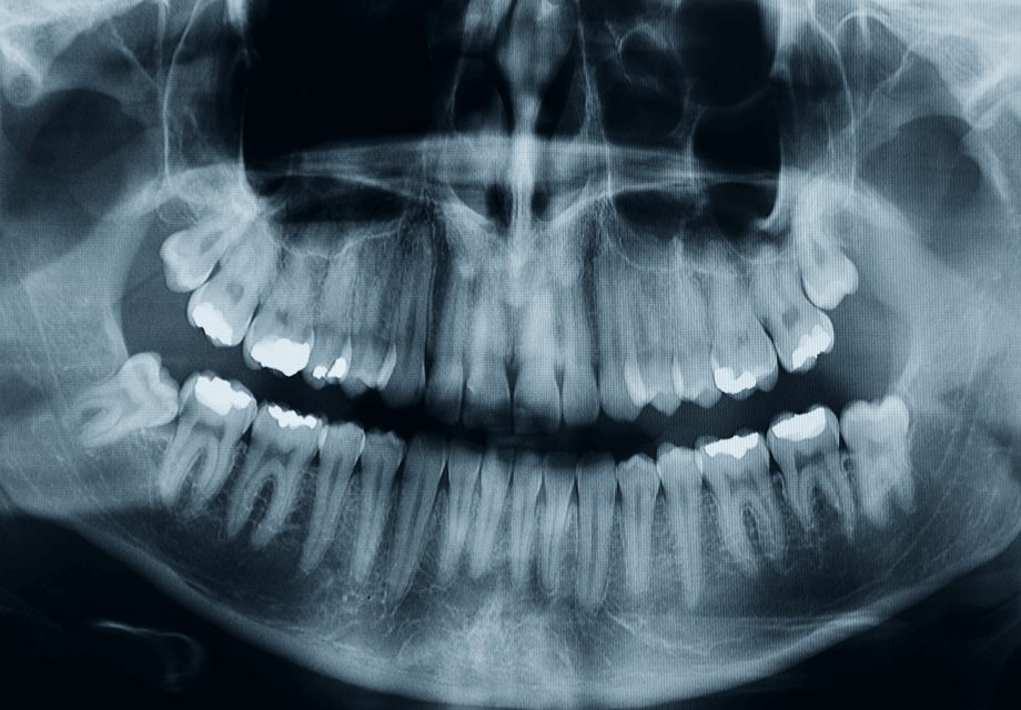 Digital X-Rays Digital X-Rays