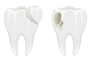 Cracked and Decayed Tooth